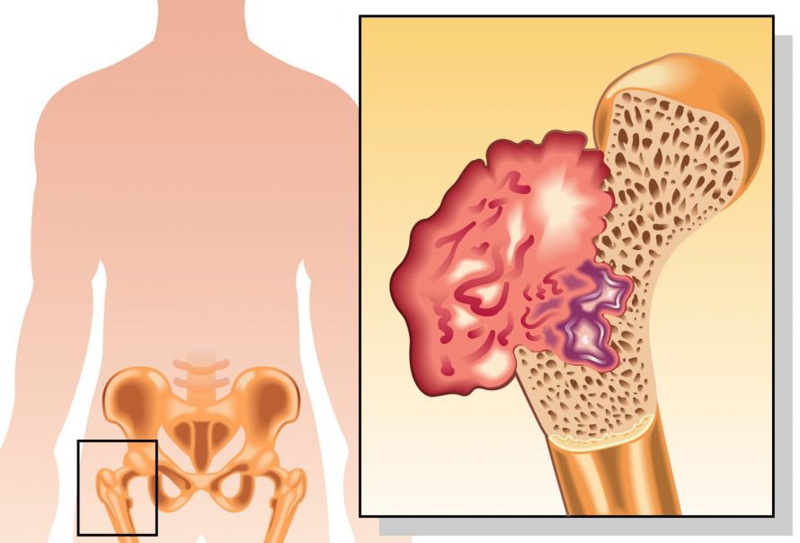 Osteosarkom Oberschenkelknochen Osteosarcoma of the Femur