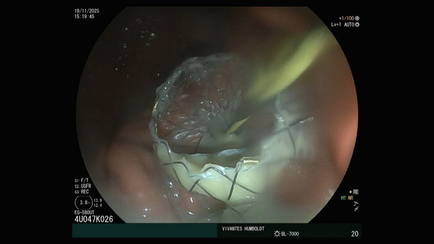 Ein Lumen-apposing-metal-stent wurde durch die Magenwand in eine infizierte Bauchspeicheldrüsenzyste eingelegt. Ein Lumen-apposing-metal-stent wurde durch die Magenwand in eine infizierte Bauchspeicheldrüsenzyste eingelegt.
