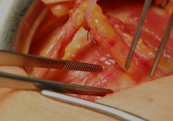 Hernien