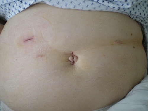 minimal-invasive Magenkrebs-OP minimal-invasive Magenkrebs-OP