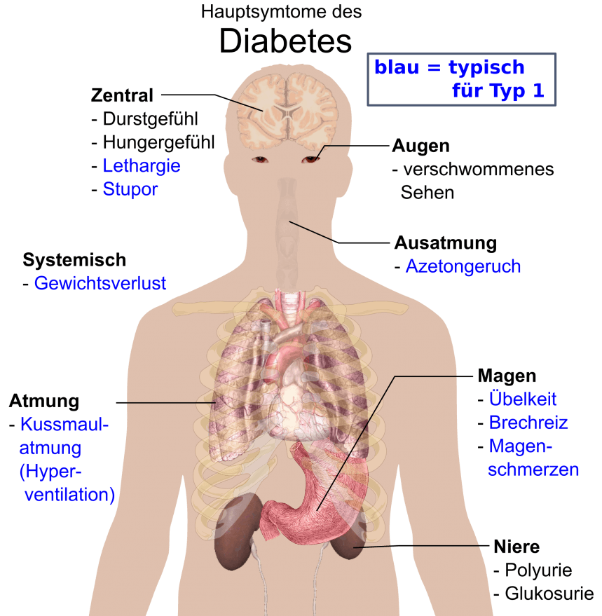 Main_symptoms_of_diabetes-de Κύρια_συμπτώματα_του_διαβήτη-de
