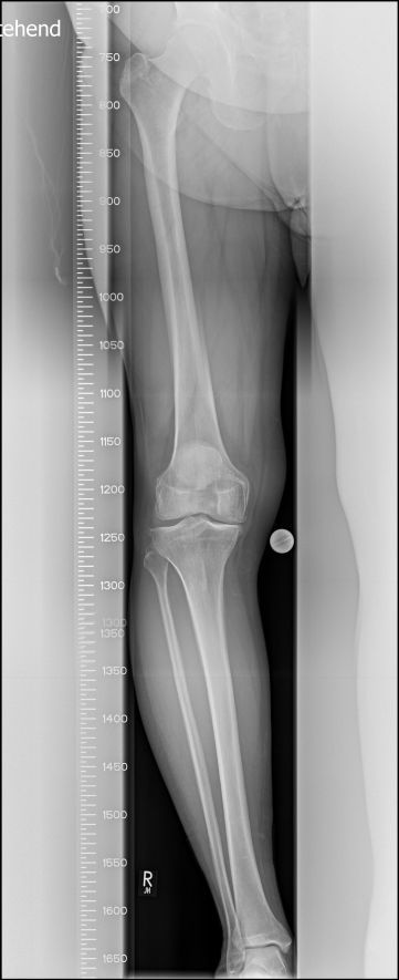 mediale Gonarthrose mediale Gonarthrose
