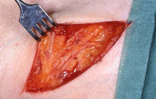 Meralgia paraesthetica1 Meralgia paraesthetica1