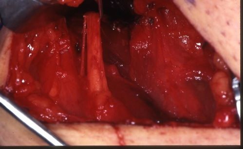 Meralgia paraesthetica2 Meralgia paraesthetica2