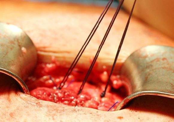 Hernien