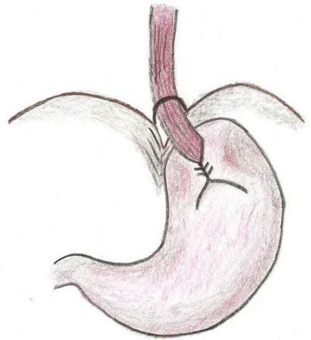 Ösophaguschirurgie 2 Ösophaguschirurgie 2