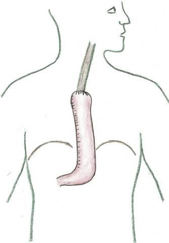 Ösophaguschirurgie 4 Ösophaguschirurgie 4