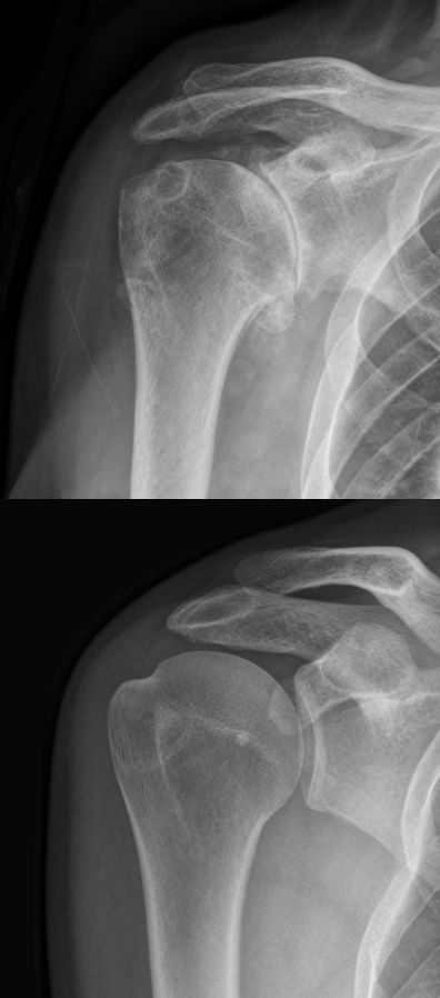 Omarthrose rechts mit gesundem Vergleich._Hellerhoff, CC BY-SA 3.0 .jpg