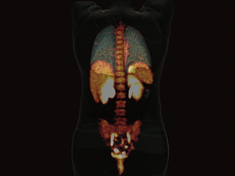 PET/CT Gerät Biograph Horizon Siemens - Bild Lungenknoten PET/CT Gerät Biograph Horizon Siemens - Bild Lungenknoten