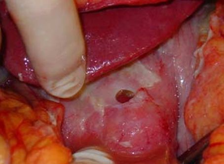 Perforation at the pylorus