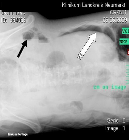Perforations in the gastrointestinal tract
