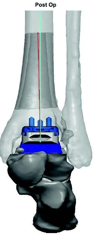 Post OP, nach Implantation. Post OP, nach Implantation.