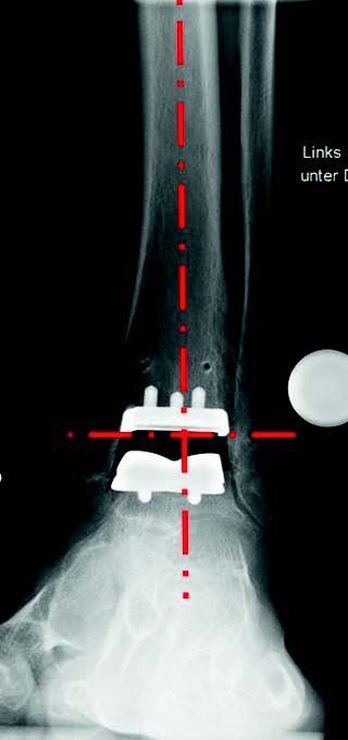 Post OP, nach Implantation. Post OP, nach Implantation.