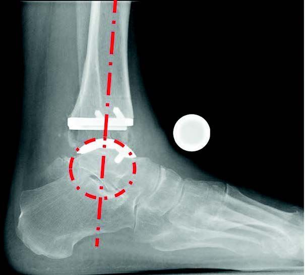 Post OP, nach Implantation. Post OP, nach Implantation.