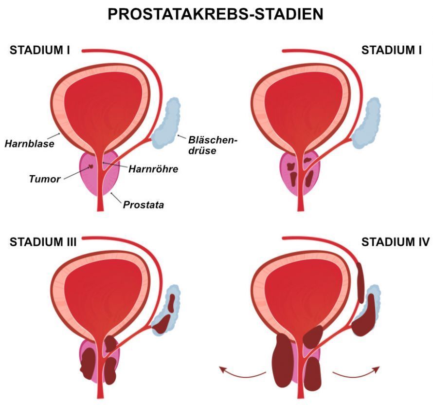 Prostata-Stadien Το διάγραμμα απεικονίζει τα διάφορα στάδια του καρκίνου του προστάτη. Η έγκαιρη διάγνωση μπορεί να βελτιώσει σημαντικά την επιτυχία της θεραπείας