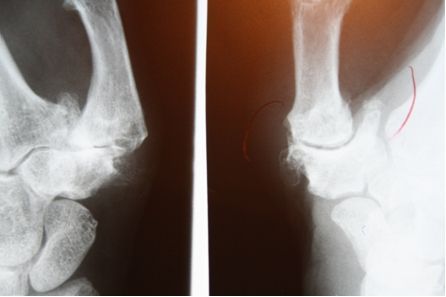 Rhizarthrose Rhizarthrosis