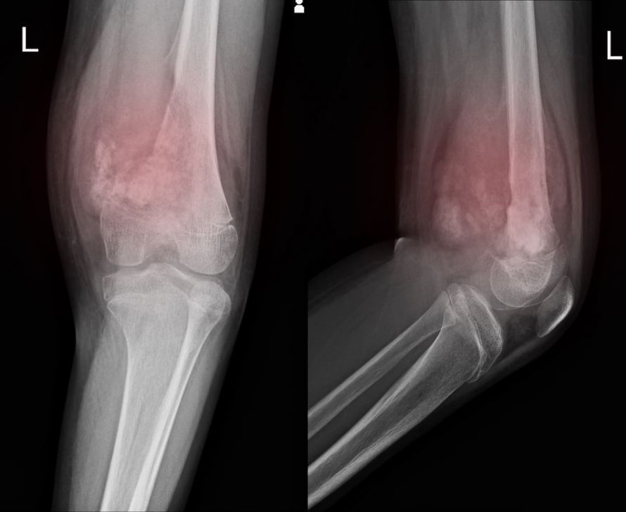 Röntgenbild Knochenkrebs X-ray of Bone Cancer