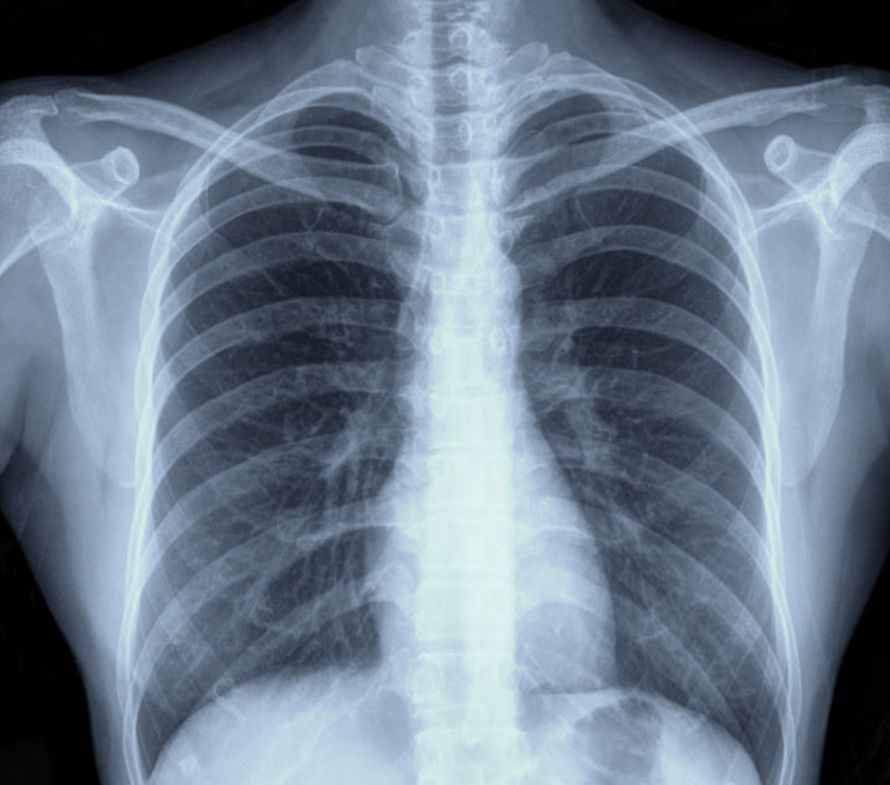 Before pectus excavatum surgery, radiologists take detailed X-rays.