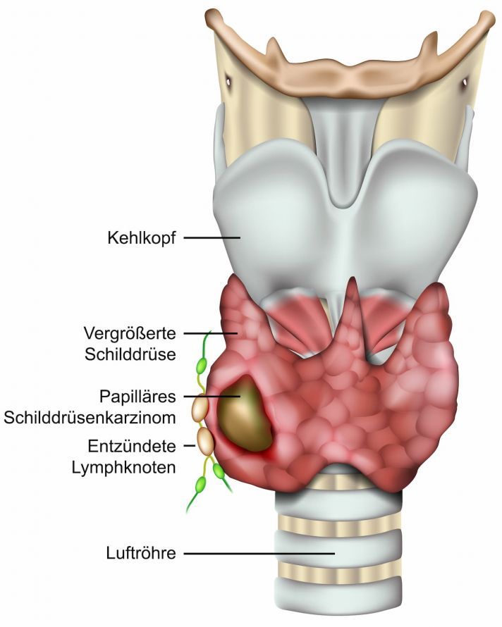 Schilddrüsenkrebs Schilddrüsenkrebs