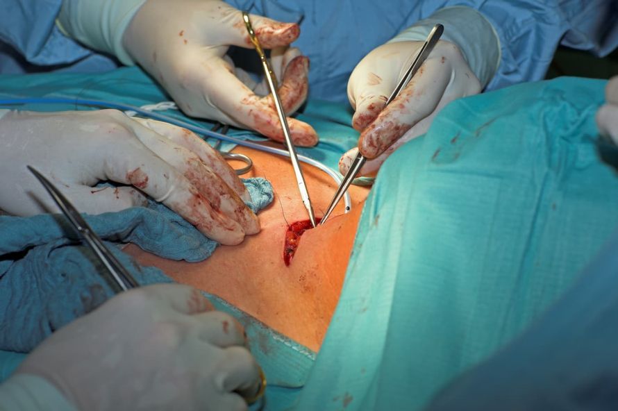 Schilddrüsenoperation Schilddrüsenoperation