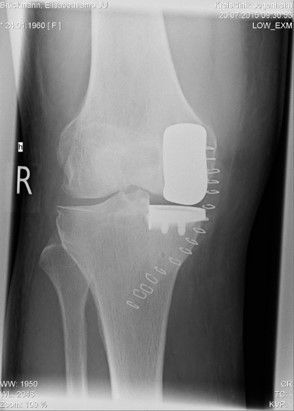 Prof. Schräder's Sled Prosthesis