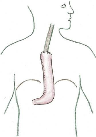 Speiseröhrenchirurgie_Rekonstruktion Magenschlauch Speiseröhrenchirurgie_Rekonstruktion Magenschlauch