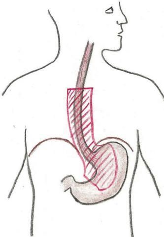 Speiseröhrenchirurgie_Resektion bei Krebs Speiseröhrenchirurgie_Resektion bei Krebs