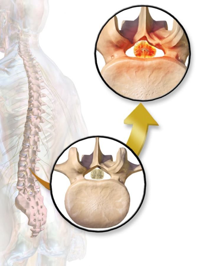 Foto Spinalkanalstenose