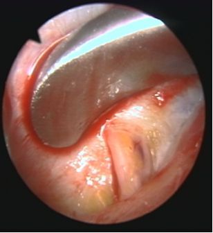 endoskopisches Stirnlifting endoskopisches Stirnlifting