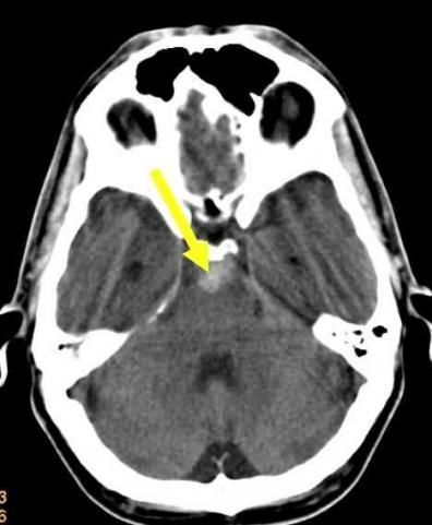Subarachnoidalblutung1 Subarachnoid hemorrhage1