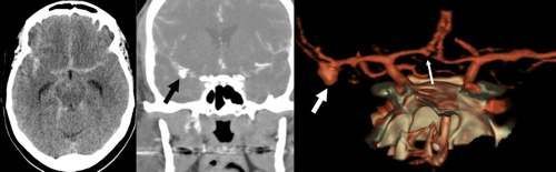 Subarachnoidalblutung2 Subarachnoid Hemorrhage 2