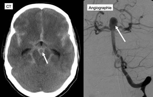Subarachnoidalblutung3 Subarachnoid hemorrhage3