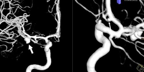 Subarachnoidalblutung4 Subarachnoid hemorrhage4