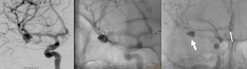 Subarachnoidalblutung5 Subarachnoid hemorrhage5
