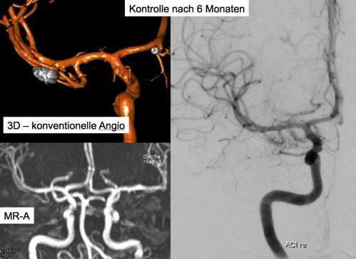 Subarachnoidalblutung6 Subarachnoid hemorrhage6