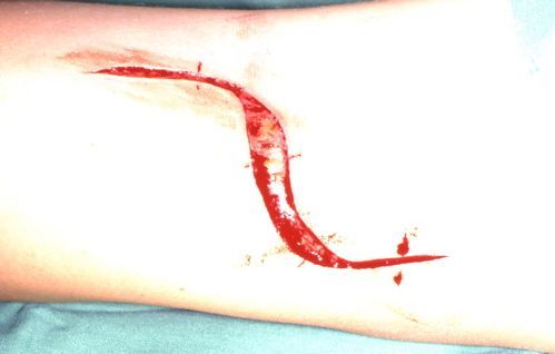 Supinatorlogensyndrom1 Supinator Log Syndrome1