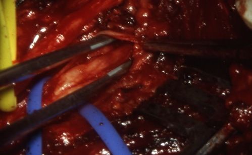 Supinatorlogensyndrom2 Supinator Log Syndrome 2