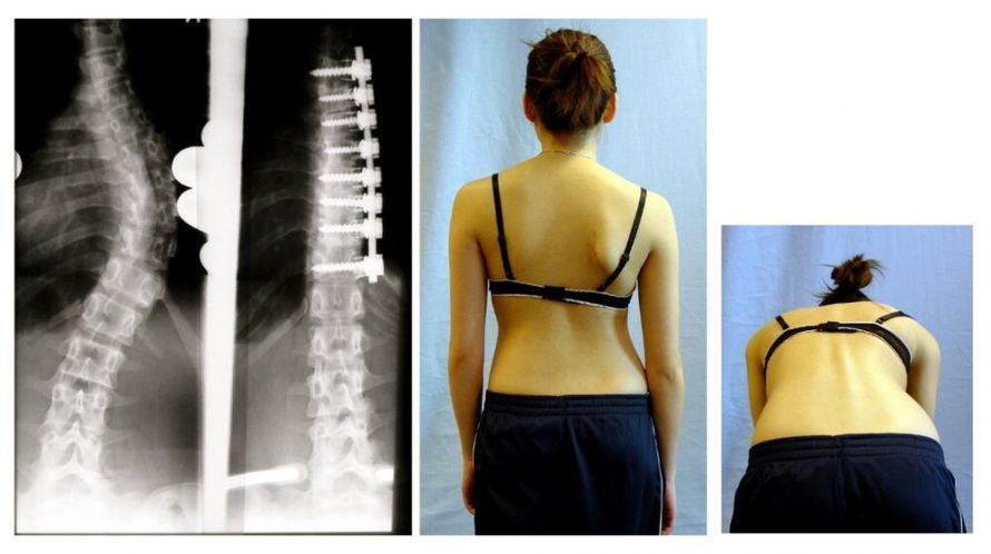 Spondylodese Spondylodese