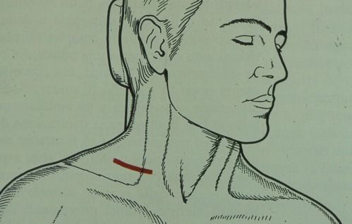 Thoracic-outlet-Syndrom1 Thoracic-outlet-Syndrom1