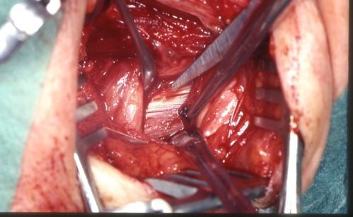 Thoracic-outlet-Syndrom2 Thoracic-outlet-Syndrom2