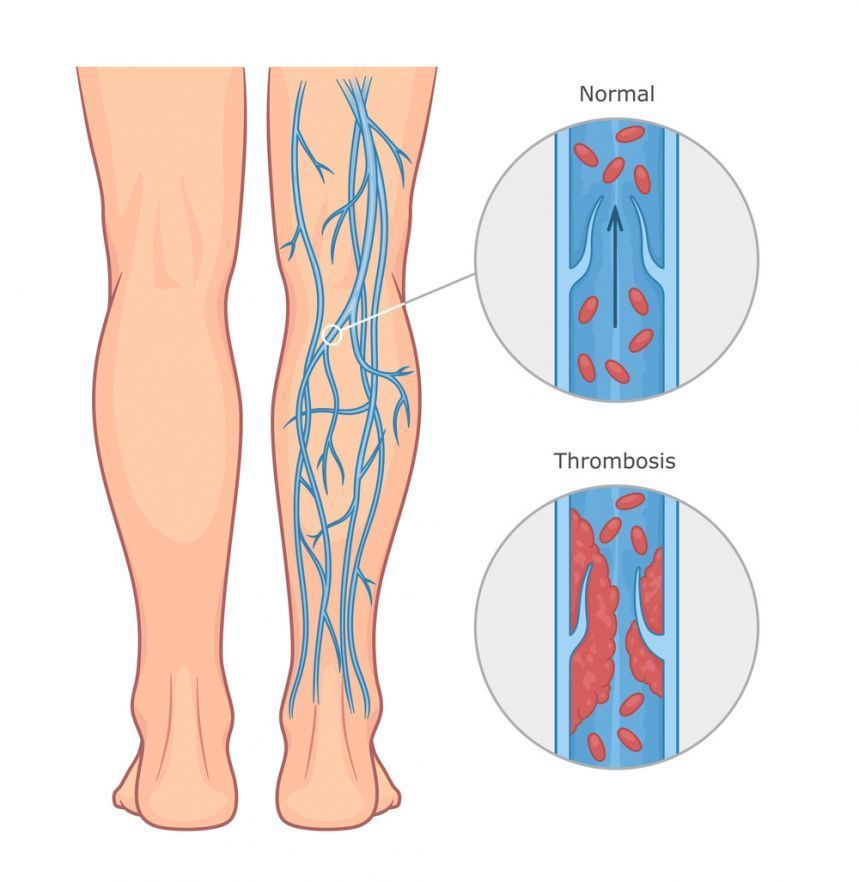 Thrombose Deep vein thrombosis in the legs