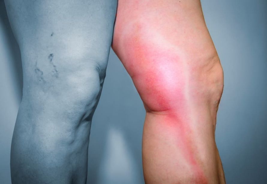Thrombose A thrombosis is often visible from the outside.