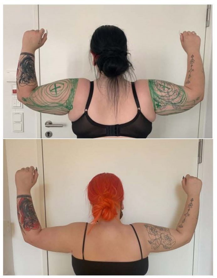 Foto Vorher Nachher Arme