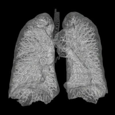 Thorax Lung 3D from CT Scans.jpg