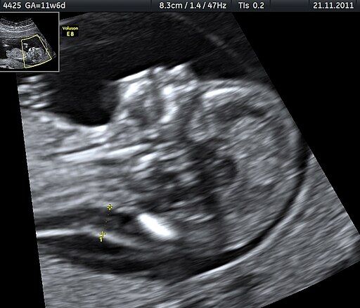 Nuchal edema in Down Syndrome Dr. W. Moroder