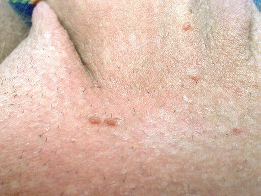 Genital warts