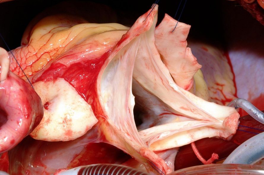Aortenklappe Aortic valve
