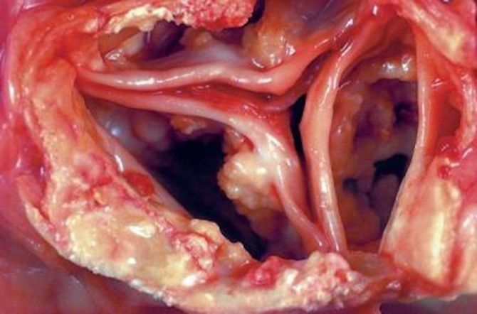 Stenostische Aortenklappe Stenotic aortic valve