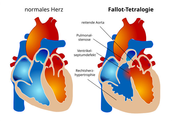 Tetralogy of Fallot de