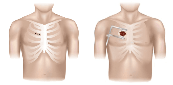 anterolaterale Mini-Thorakotomie anterolateral mini-thoracotomy